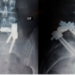 A "lumbar interbody fusion," an operation in which the surgeon builds a metal cage around the spine.